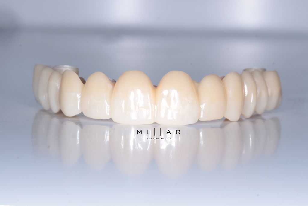 Full Arch sobre 4 a 6 Implantes