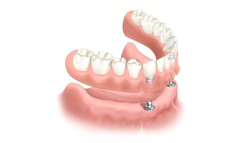 Dentadura Inferior sobre 2 Implantes